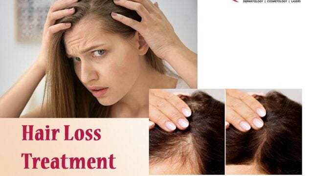 Best Hair Loss Treatment Clinics in Bangalore: Get Results Now!