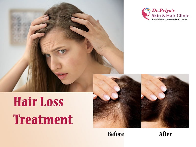 Best Hair Loss Treatment Clinics in Bangalore: Get Results Now!